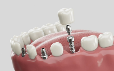 Dental Implants