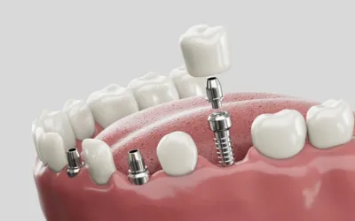Dental Implants - Dental Creations Dental Implants