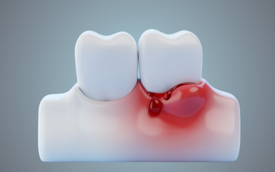 Periodontics