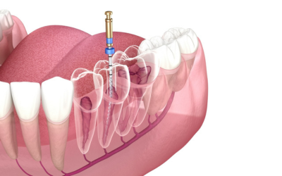 Root Canal Treatment