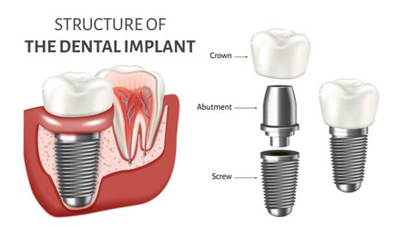 What Are Dental Implants