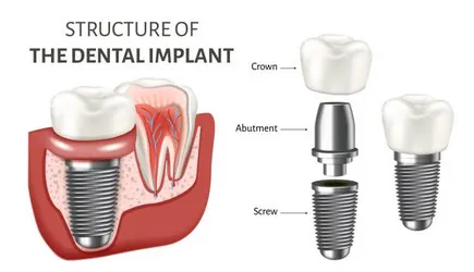What Are Dental Implants What Are Dental Implants
