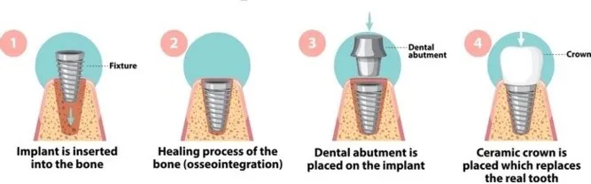 Our Step-by-Step Implant Process