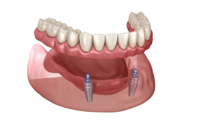 Full mouth Dental implant