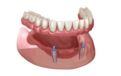 Untitled_design (2) - Dental Creations Full mouth Dental implant