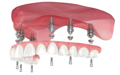 Full mouth Dental implant