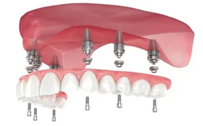 Full Mouth Rehabilitation - Dental Creations Full mouth Dental implant