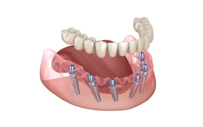 Full mouth Dental implant