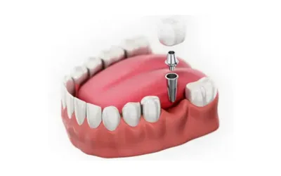 Untitled_design_(18) - Dental Creations Full mouth Dental implant