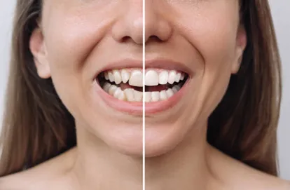 Benefit-of-Invisalign