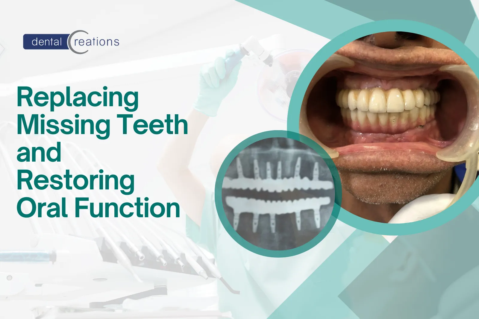 Replacing Missing Teeth and Restoring Oral Function