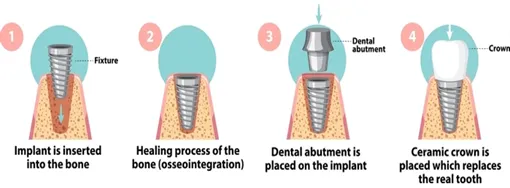 Full-Mouth-Dental-Implants