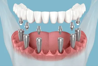 What-Are-Full-Mouth-Dental-Implants