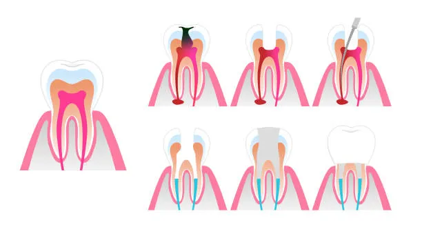 Root-Canal-Treatment-and-Dental-Crowns