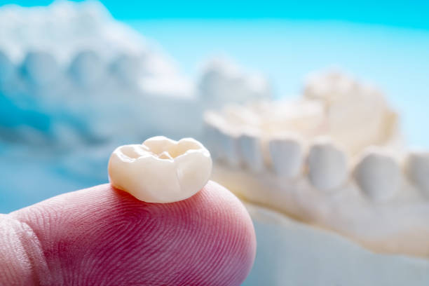 Root-Canal-Treatment-and-Dental-Crowns Root-Canal-Treatment-and-Dental-Crowns