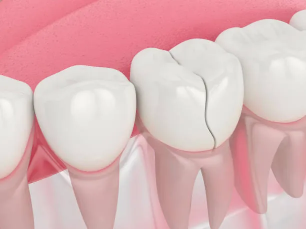  Common-Causes-of-Dental-Crown-Pain-After-Root-Canal