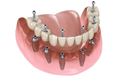 Full mouth dental implant - Dental Creations