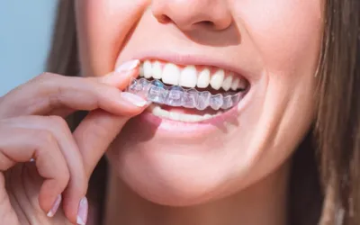 Invisalign Clear Aligners - Dental Creations