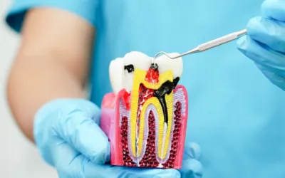 Root Canal Treatment 2 - Dental Creations