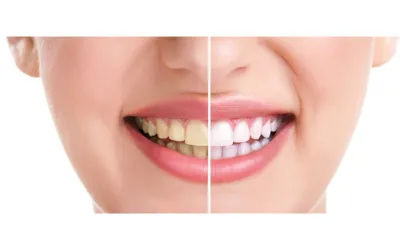 Teeth whitening 1 - Dental Creations