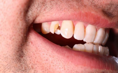 Cracked tooth