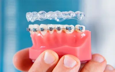 Braces Aligners - Dental Creations