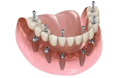 Full-mouth-rehabilitation - Dental Creations
