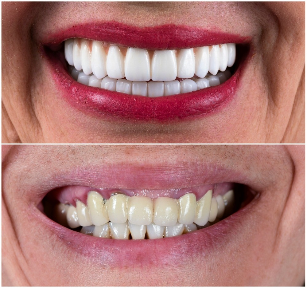 Who Can Benefit from Dental Implants?