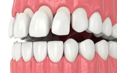 Composite - Dental Creations
