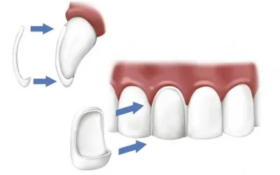 No prep veneers - Dental Creations No-prep-veneers