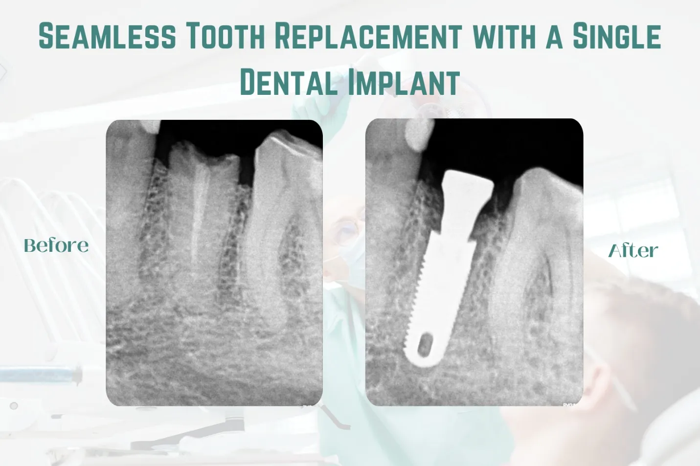 Seamless Tooth Replacement with a Single Dental Implant