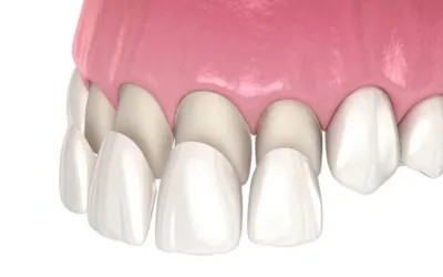 Porcelain 1 - Dental Creations