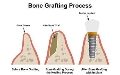 Bone-Grafting-Process