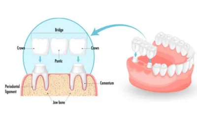 Dental-Crowns-Bridges