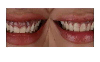 Gum-Contouring-Gingival-Aesthetics