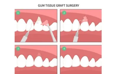Gum-Grafting