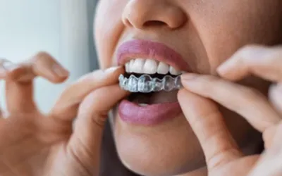 Invisalign-Clear-Aligners