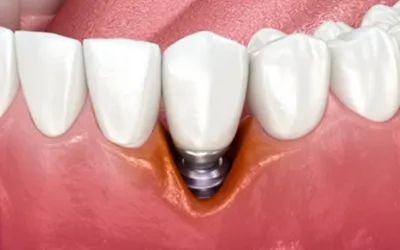 Peri-Implantitis
