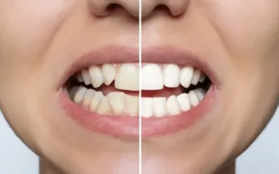 Porcelain-Veneers