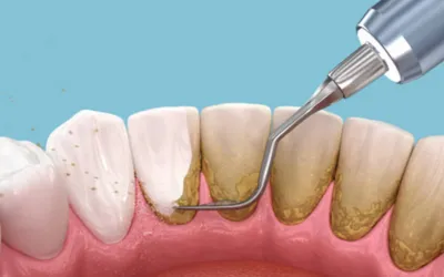 Scaling-and Root-Planing