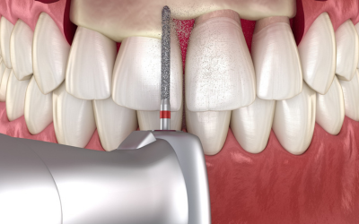 crown-lengthening