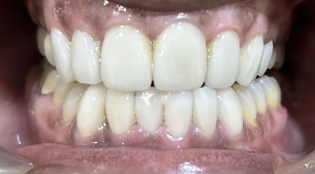 Smile-Rehabilitation-after
