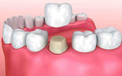 Dental Crown - Dental Creations