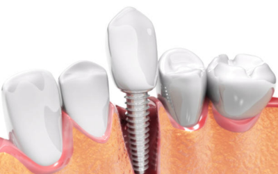 Dental Implant - Dental Creations