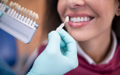 Dental Veneers 1 - Dental Creations