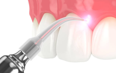 Gum Contouring 1 - Dental Creations gummy smile