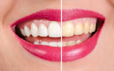 Teeth whitening 1 - Dental Creations