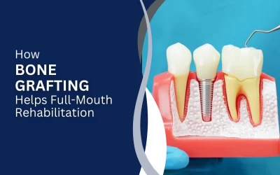 How Bone Grafting Helps Full Mouth Rehabilitation
