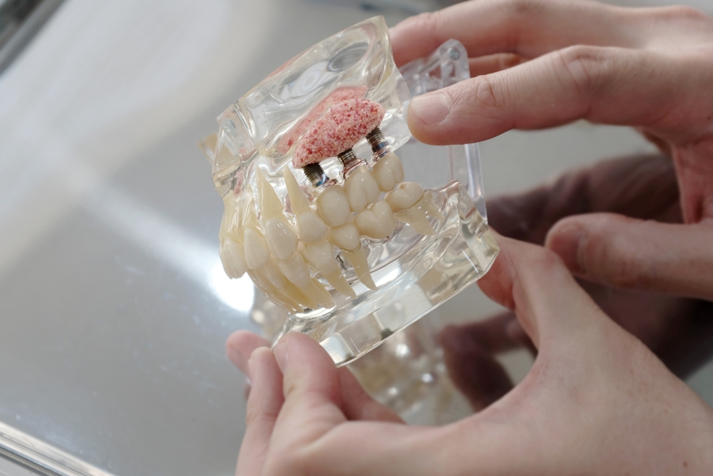 bone grafting and sinus lift