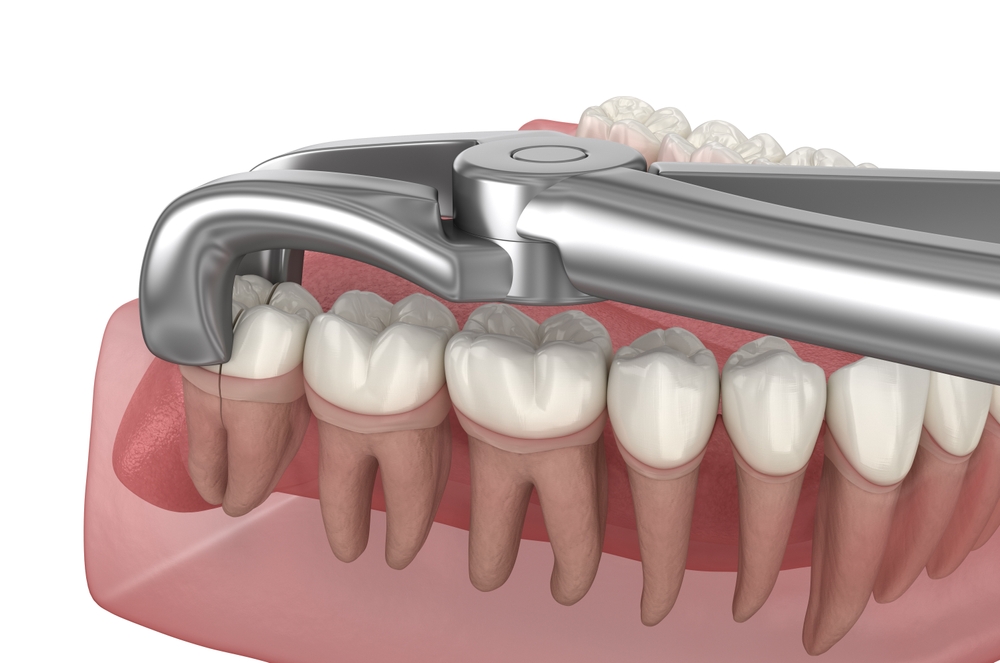 wisdom tooth extraction